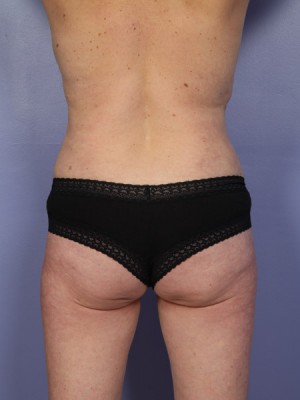 Tummy Tuck