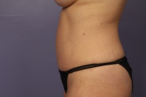 Tummy Tuck