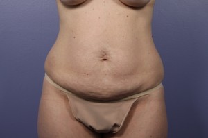 Tummy Tuck