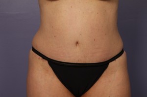 Tummy Tuck