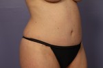 Tummy Tuck