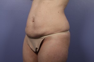 Tummy Tuck