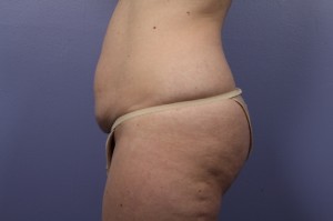 Tummy Tuck