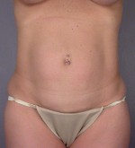 Tummy Tuck