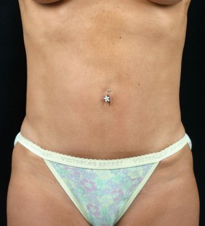 Tummy Tuck