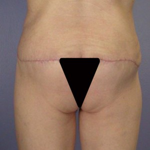 Tummy Tuck