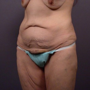 Tummy Tuck