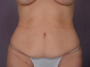 Tummy Tuck