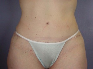 Tummy Tuck