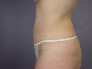 Tummy Tuck