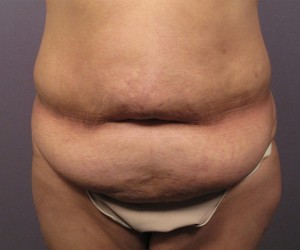 Tummy Tuck