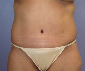 Tummy Tuck