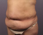 Tummy Tuck