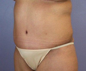 Tummy Tuck