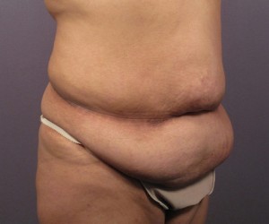 Tummy Tuck