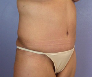 Tummy Tuck