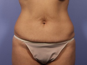 Tummy Tuck