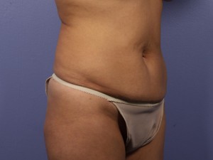 Tummy Tuck