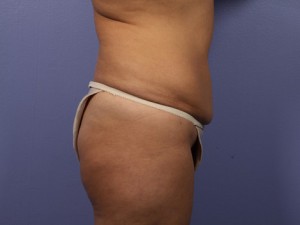 Tummy Tuck