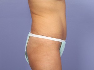 Tummy Tuck