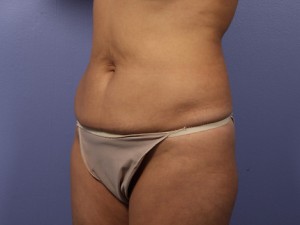 Tummy Tuck