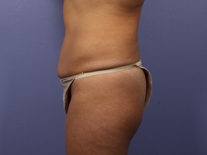 Tummy Tuck