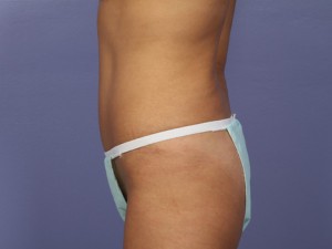 Tummy Tuck