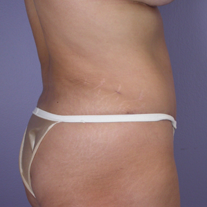 Tummy Tuck