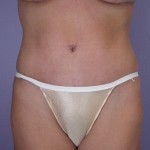 Tummy Tuck