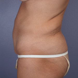 Tummy Tuck