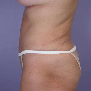 Tummy Tuck