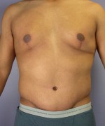 Tummy Tuck