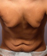 Tummy Tuck