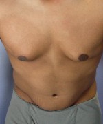 Tummy Tuck