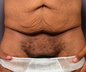 Tummy Tuck