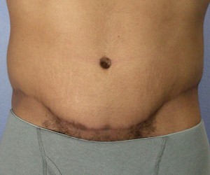 Tummy Tuck