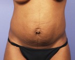 Tummy Tuck