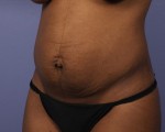 Tummy Tuck