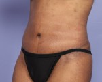 Tummy Tuck