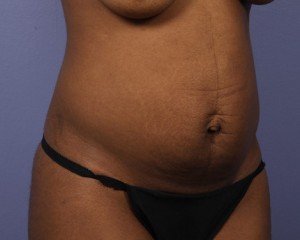 Tummy Tuck