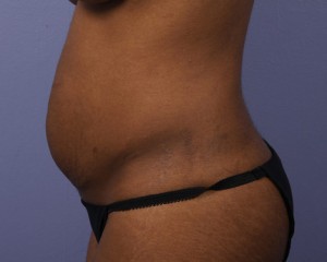 Tummy Tuck