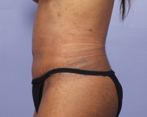 Tummy Tuck