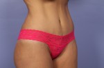 Tummy Tuck