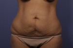 Tummy Tuck