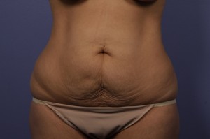 Tummy Tuck