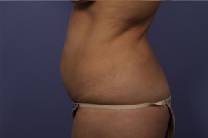 Tummy Tuck