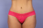 Tummy Tuck