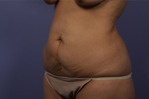 Tummy Tuck