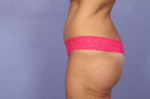 Tummy Tuck