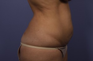 Tummy Tuck